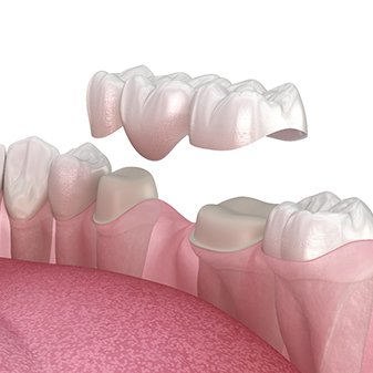 an illustration of a traditional dental bridge