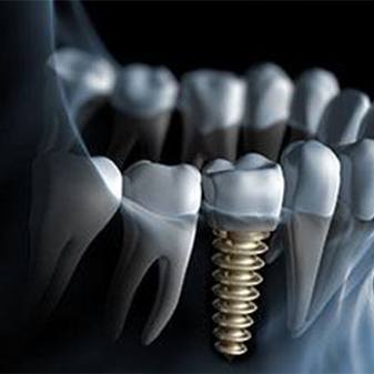 Animated smile with dental implant supported dental crown during osseointegration