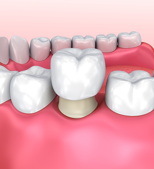 Animated smile during dental crown placement