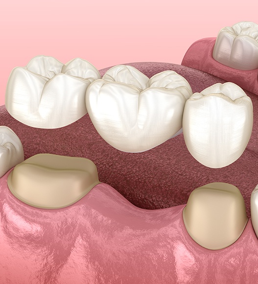 Animated smile during dental bridge placement