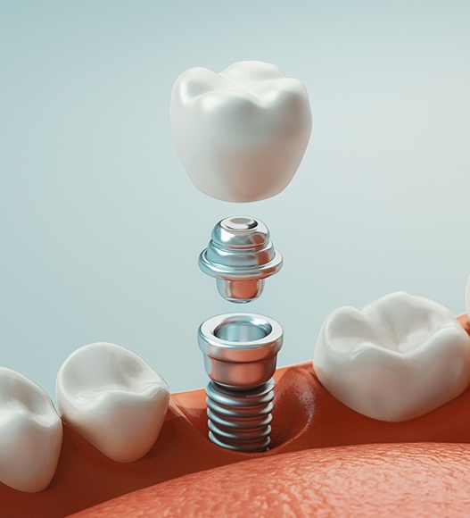 Animated dental implant supported dental crown components