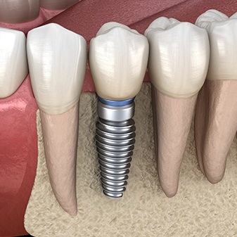 Animated smile with dental implant supported dental crown in place