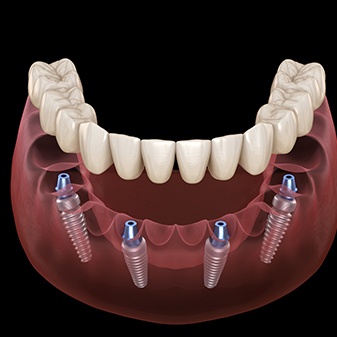 Animated dental implant supported denture placement