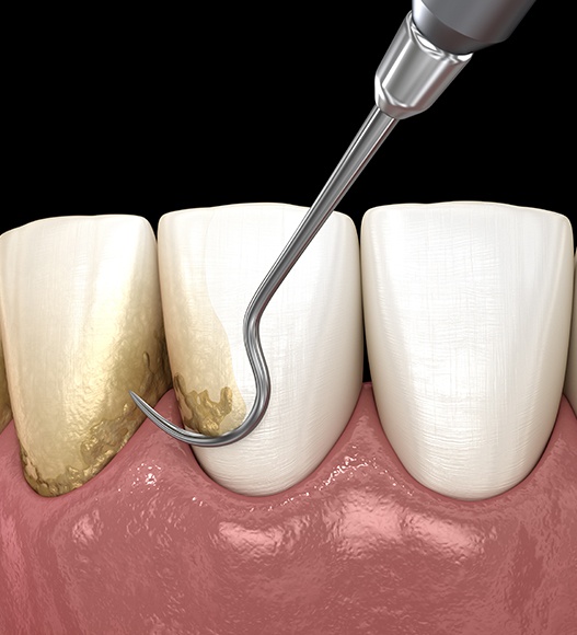 Animated smile during scaling and root plaing periodontal disease treatment