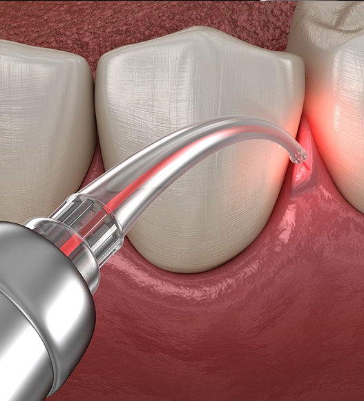 Animated smile during laser periodontal therapy