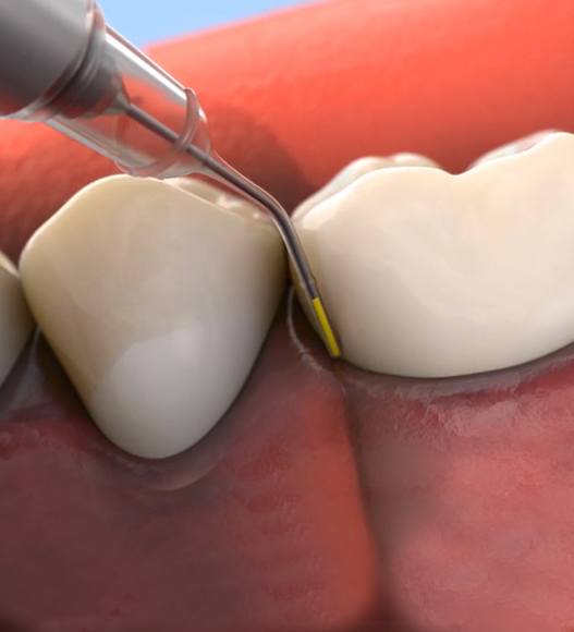 Animated smile during Arestin antibiotic therapy treatment