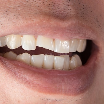 Closeup of smile with broken front tooth