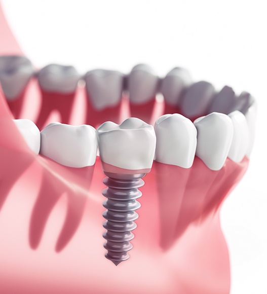 Animated dental implant supported dental crown