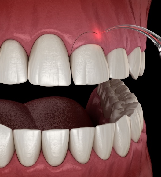 Animated smile during gum recontouring treatment