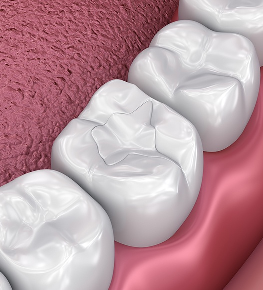 Animated smile after tooth colored filling restorative dentistry treatment