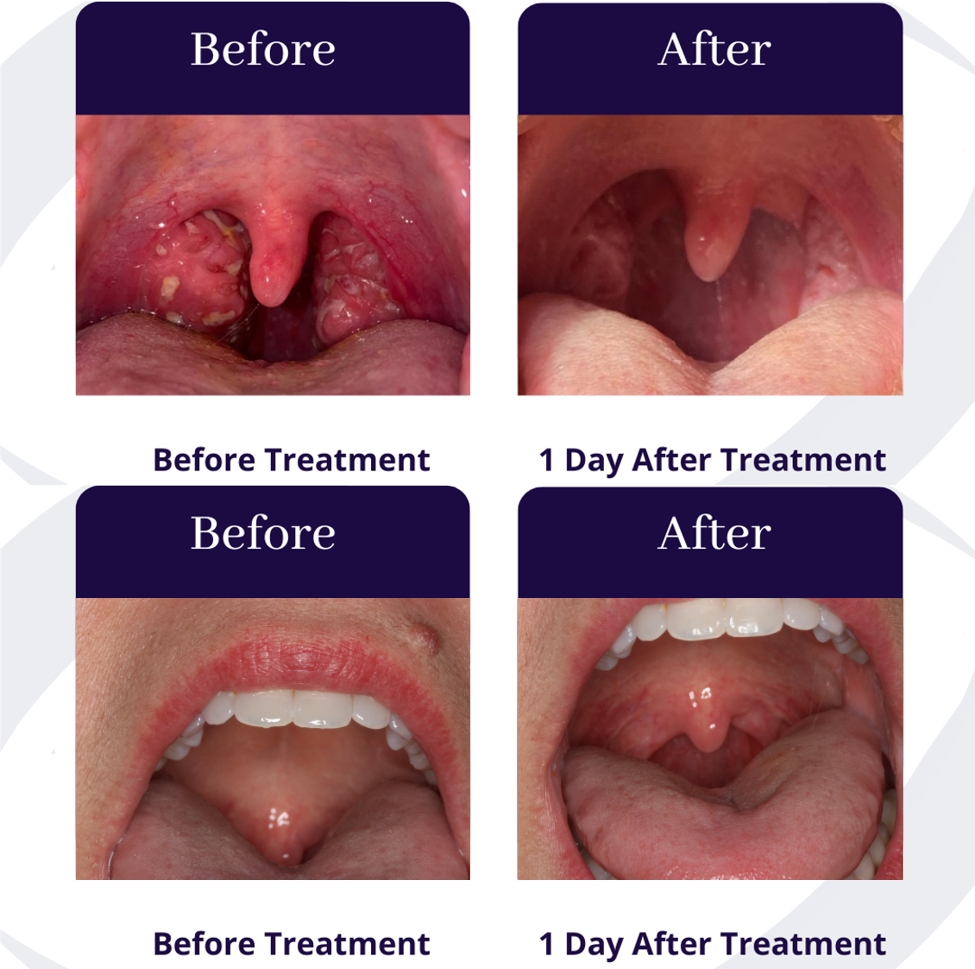 Interior of patient’s mouth before and after QuiteNite treatment