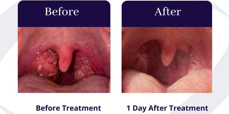 Interior of patient’s mouth before and after QuiteNite treatment