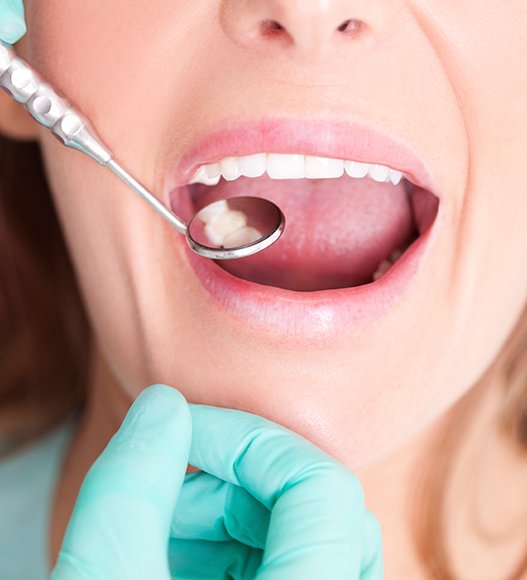 Dentist examining patient's smile after tooth colored filling treatment