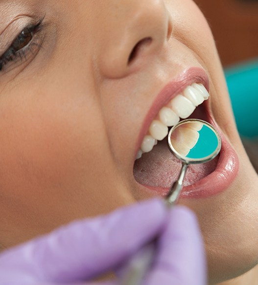 Patient with flawless smile after tooth colored filling placement