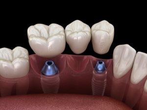 Three-unit bridge, one of the types of dental implants