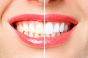 Woman’s stained teeth before and after cosmetic treatment