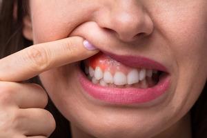 Woman pulling up lip to show swollen gum tissue
