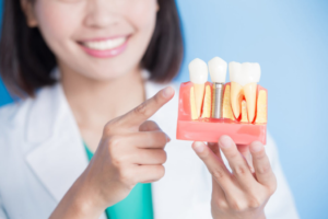 a closeup of a model of dental implants 